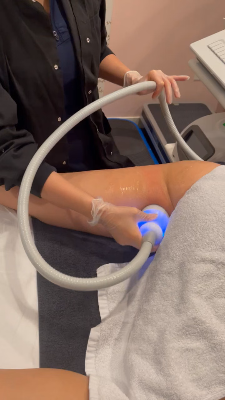 Cryo T-Shock applicator used during a body-contouring session