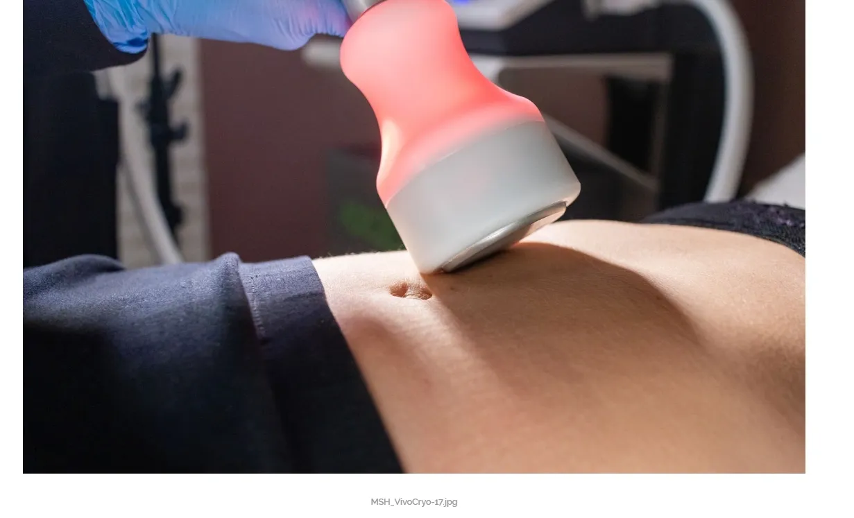 Temperature-based applicator used during a Viva Cryo session